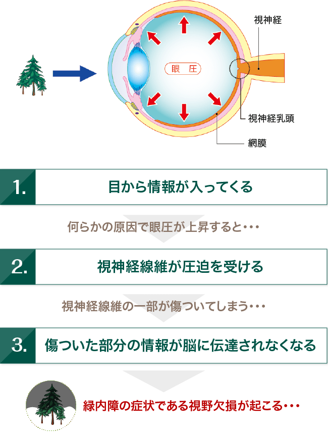 眼 圧 高い 原因